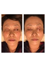 エシャーム(echarme)/Newアイス高周波