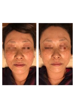 エシャーム(echarme)/Newアイス高周波