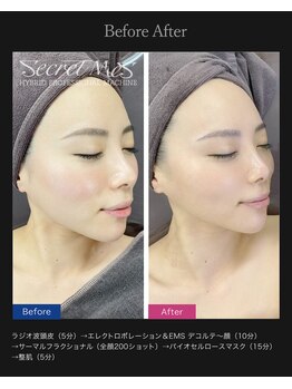 ピュールマロン ムッシュタロウ 桑名店(Pure Marron M.Taro)/二重あご撃退+サーマル