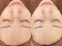 フルーブラン(Frubran)/光フォトで透明感UP◎肌質改善へ