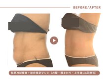 イエス マイサロン(yes My Salon)/脂肪冷却＋痩身施術症例