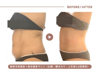イエス マイサロン(yes My Salon)/脂肪冷却+痩身施術症例
