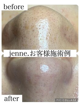 ジェンヌ(jenne.)の写真/当店お勧めNo.1【毛穴エクストラクション×エンビロン】¥8500~お悩み別エンビロン美容液導入コ-ス¥11800♪