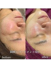 ビエン(bien)/施術6回.陶肌ハーブピーリング