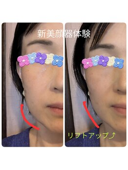 アヤズ サロン(AYA's SALON)/新美顔器「ルミエ」体験