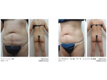 Nビューティー/エンダモロジー×サーモシェイプ