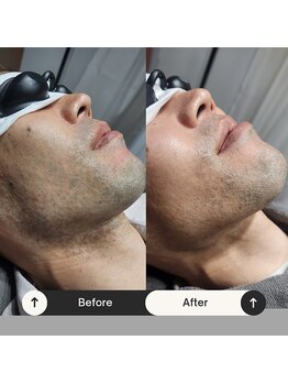 ユーフェム(U-fem)/ヒゲ10回目のお客様