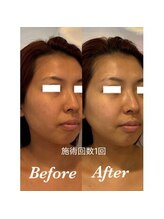 ティアラ(TIARA)/【小顔、たるみ】テラボーラー