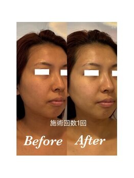 ティアラ(TIARA)/【小顔、たるみ】テラボーラー