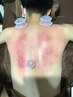 【アロマオイルトリートメント】肩甲骨はがしとスライドカッピング　60分
