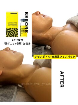 エステティックス ナインワンワン 横浜(Esthetics911) /レモンボトルで小顔リフトアップ