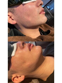 メンズサロン エイチ(H)/髭脱毛