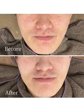 ニキビケア研究所 池袋店/毛穴・乾燥・赤みなども改善！