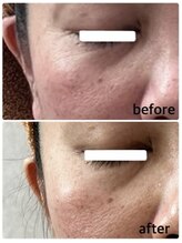 プロッソル こころ(PROSOL)/【NEW】光フェイシャル/しわケア