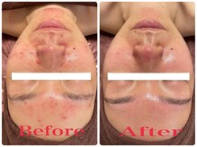 ルネル(Lunelle)/ハーブピーリングニキビケア