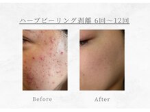 エヴァーグレース 三河安城店(EVER GRACE)/【肌管理】ハーブピーリング剥離