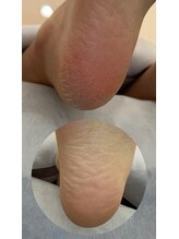 フットミー(foot mii)/足裏角質ケア/韓国美容