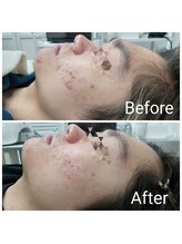 レン(Ren)/ハーブピーリング（剥離なし1回