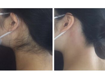 ミカ ネスト(Mika Nest)/光脱毛/SHR /IPL