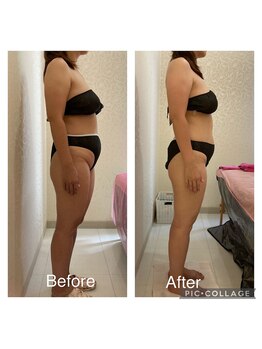 アンフィー 川西能勢口店(Une f`ee)/泡痩身のビフォーアフター★