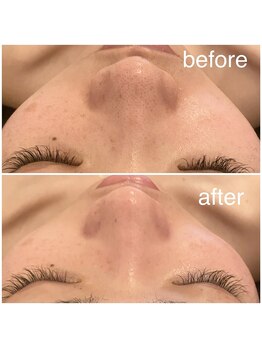 プール エドボリ(POOL EDOBORI)/頑固な黒ずみもスッキリ◎