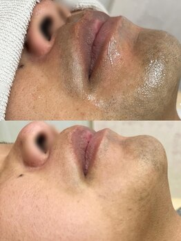 ジュエリー アンド ティアラ(Jewelry & Tiara)の写真/メンズ脱毛はデキる男の新常識！清潔感&第一印象UP！都度払いOK！人目を気にせず通えるプライベート空間！