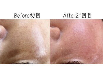 エリア(area.)/8、【シミケア15分】