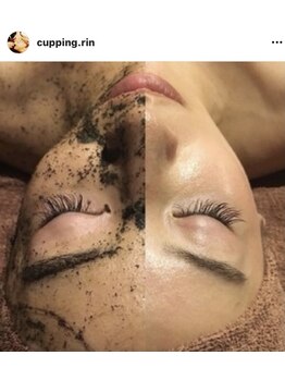 カッピングアンドカッサ専門店 凜(Rin)/陶肌トリートメント