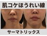 【ほうれい線集中ケア】サーマトリックスほうれい線改善/たるみ改善◎