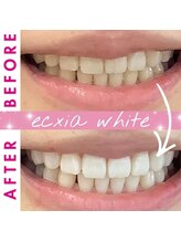 エクシアホワイトフジ(ecxia white fuji)/ホワイトニングビフォーアフター