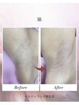 ベルミーランド MEGAドン・キホーテ桐生/脱毛 Before→After