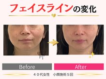 タイナ(taina)/40代女性/小顔施術5回