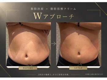 ビュウナ 銀座(BEAUNA)の写真/寝たまま受けられる◎脂肪冷却と高出力マシンでぽっこりお腹を徹底ケア！フェイシャル機器も多数ご用意♪