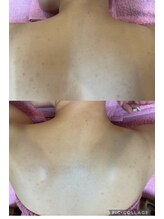 シェービング アンド エステ ローズマリー(Rosemary)/背中のシェービング♪