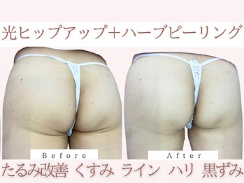 Cスキンケアクリニック 麻布店/光+ヒップハーブBeforeAfter