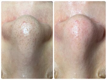 マリアム(mariam)/毛穴エクストラクション