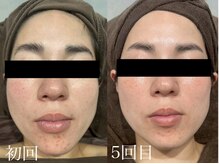 チャマ 高知店(CHAMA)/30代　水光ピール　ニキビ改善