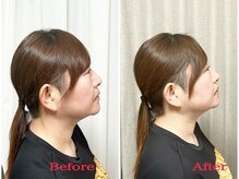 シルフィード/フェイスラインすっきり