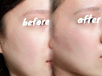 ミーククル(MEKUKURU)/フェイスワックス/顔脱毛