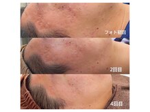 フルーブラン(Frubran)/光フォトで透明感UP◎肌質改善へ