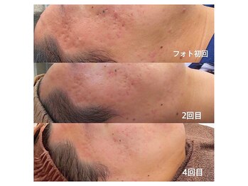 フルーブラン(Frubran)/光フォトで透明感UP◎肌質改善へ