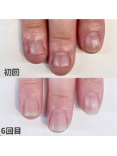 ココデネイル(cocode nail)/爪噛みによる深爪【１】