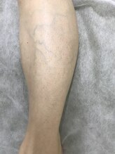 ナノハナ/鹿沼市本格全身脱毛ナノハナ