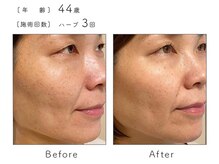 チップ(chip)/44歳／施術3回