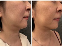 エステティック エルローザ(Esthetique elle Rosa)/レモンボトル 小顔にはこれ！