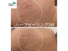 バイオビューティー 神戸本店(Bio Beauty)/ハーブピーリング症例