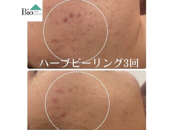 バイオビューティー 神戸本店(Bio Beauty)/ハーブピーリング症例