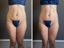 リジュ(Reju)/ハイパーナイフEX＋シェイプ痩身