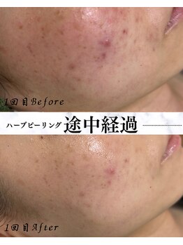 サロン ド エン(Salon de. en)/大人ニキビ◇ハーブピーリング