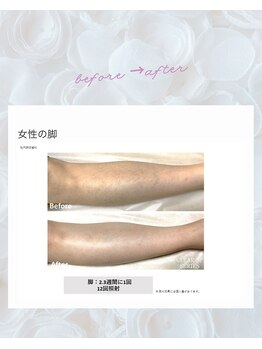 ノノ(nono)/膝下脱毛